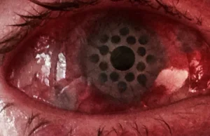 Tak wygląda oko po przeszczepie rogówki
