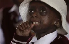 12-letnia dziewczynka chora na progerie