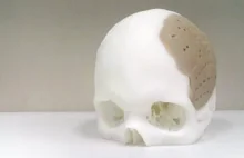 75% czaszki pacjenta zastąpiono implantem wyprodukowanym na drukarce 3D