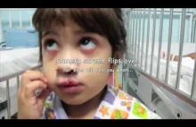 Dziewczynka z rozszczepem wargi widzi się po raz pierwszy po operacji