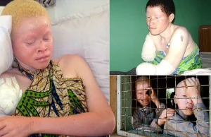 W Tanzanii uważa się, że kończyny albinosów przynoszą szczęście.