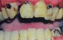 Dentysta, który leczy zęby zrujnowane przez metamfetaminę