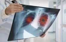 Fatalne wyniki leczenia raka płuca w Polsce. 90% chorych umiera w ciągu 5 lat