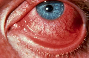 Lekarz przepisał krem na erekcję zamiast maści na suche oko [ENG]