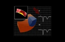 Czy wiesz: Jak zmienia się zapis EKG w trakcie zawału serca?