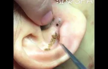 Zaskórnik sporych rozmiarów znaleziony w uchu