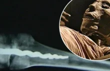 Wewnątrz mumii sprzed 3000 lat odkryto zaawansowany implant ortopedyczny