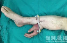 Lekarze przyszyli rękę do nogi, aby ją ocalić
