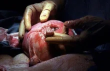21-tygodniowe dziecko wyciąga rączkę i łapie lekarza za palec. Dziś ma 16 lat.