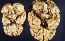 Wyhodowano czteromilimetrowy ludzki mózg z komórek skóry