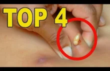 TOP 4 Best Video for this Week ! CYST, BOT FLY & Incredible BLACKHEAD