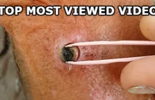 BLACKHEAD & PORE OF WINER - Top MOST VIEWED Video !