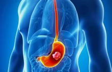 Rak żołądka - Co to za choroba ?
