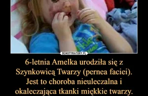 6 letnia Amelka urodzila sie z powazna wada twarzy!