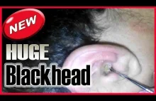 Blackhead extraction tool. Removal huge blackhead in the ear - All pimples...