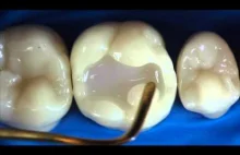 Odbudowanie zębów w technologii Smart Dentin Replacement