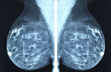Mammografia nie zmniejsza liczby zgonów na raka piersi