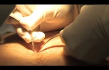 Usunięcie wyrostka robaczkowego metodą laparoskopową...
