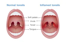 Angina: przyczyny, objawy i leczenie
