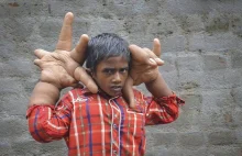 Hindus z dłońmi większymi od głowy. Straszna choroba (GALERIA)