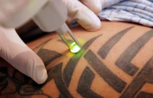 Wszystkie formy tatuażu są możliwe do usunięcia za pomocą metody laserowej...
