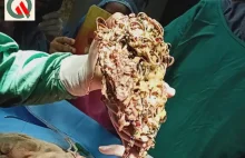 Skarżyła się na ból brzucha. W żołądku było 1,6 kg biżuterii