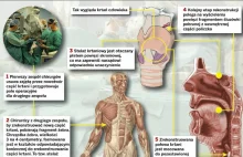 Niesamowita operacja gliwickich chirurgów. Krtań z żebra, policzka i powieki!