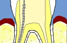 Na czym polega leczenie kanałowe?
