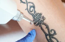 Jak usunąć tatuaż? Poznaj skuteczną metodę!