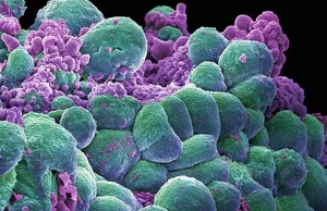 Naukowcy z Seattle: Chemioterapia powoduje wzrost komórek nowotworowych