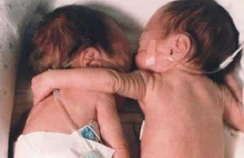 Nowo narodzona dziewczynka objęła umierającą siostrę i uratowała jej życie