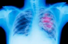 Coraz więcej niepalących choruje na raka płuc
