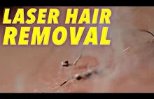 Laserowe usuwanie włosów