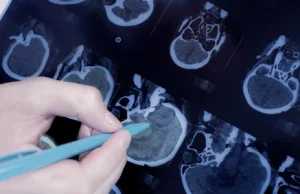 Krok do stworzenia leku na wyjątkowo zabójczego raka mózgu