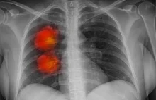 Nowy lek na raka płuc znacznie skuteczniejszy niż chemioterapia