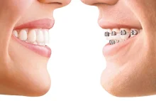 Niewidoczne aparaty ortodontyczne INVISALING