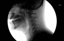 Jak wygląda połykanie płynów (rentgen)