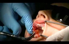 Usunięcie wszystkich zębów i przygotowanie do wstawienia implantów.
